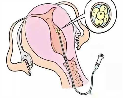 试管婴儿移植30天出血应该如何回事~代生子包成功